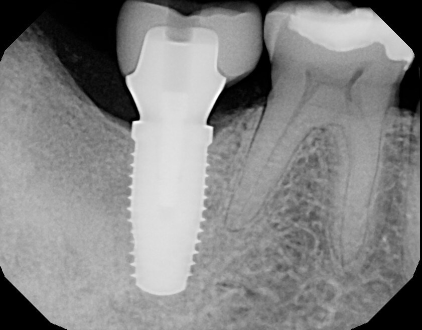 Custom abutment and crown Final