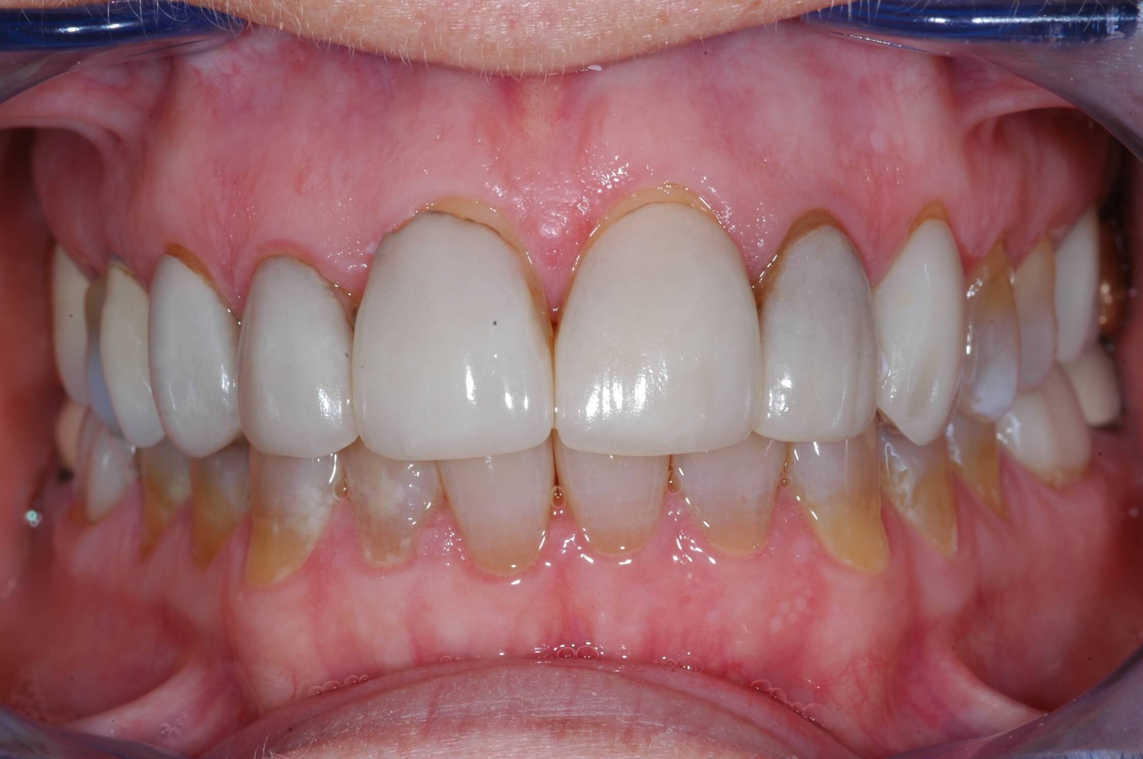 Retracted photos Before
