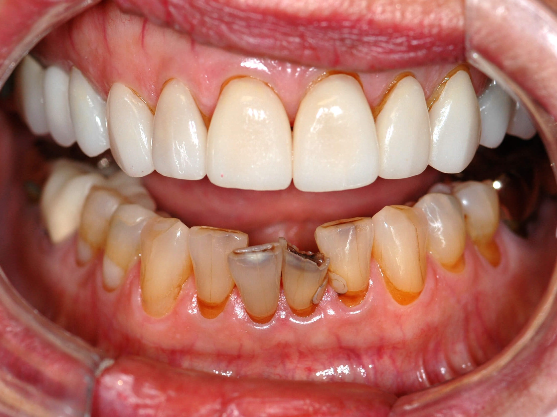 Her lower teeth Before