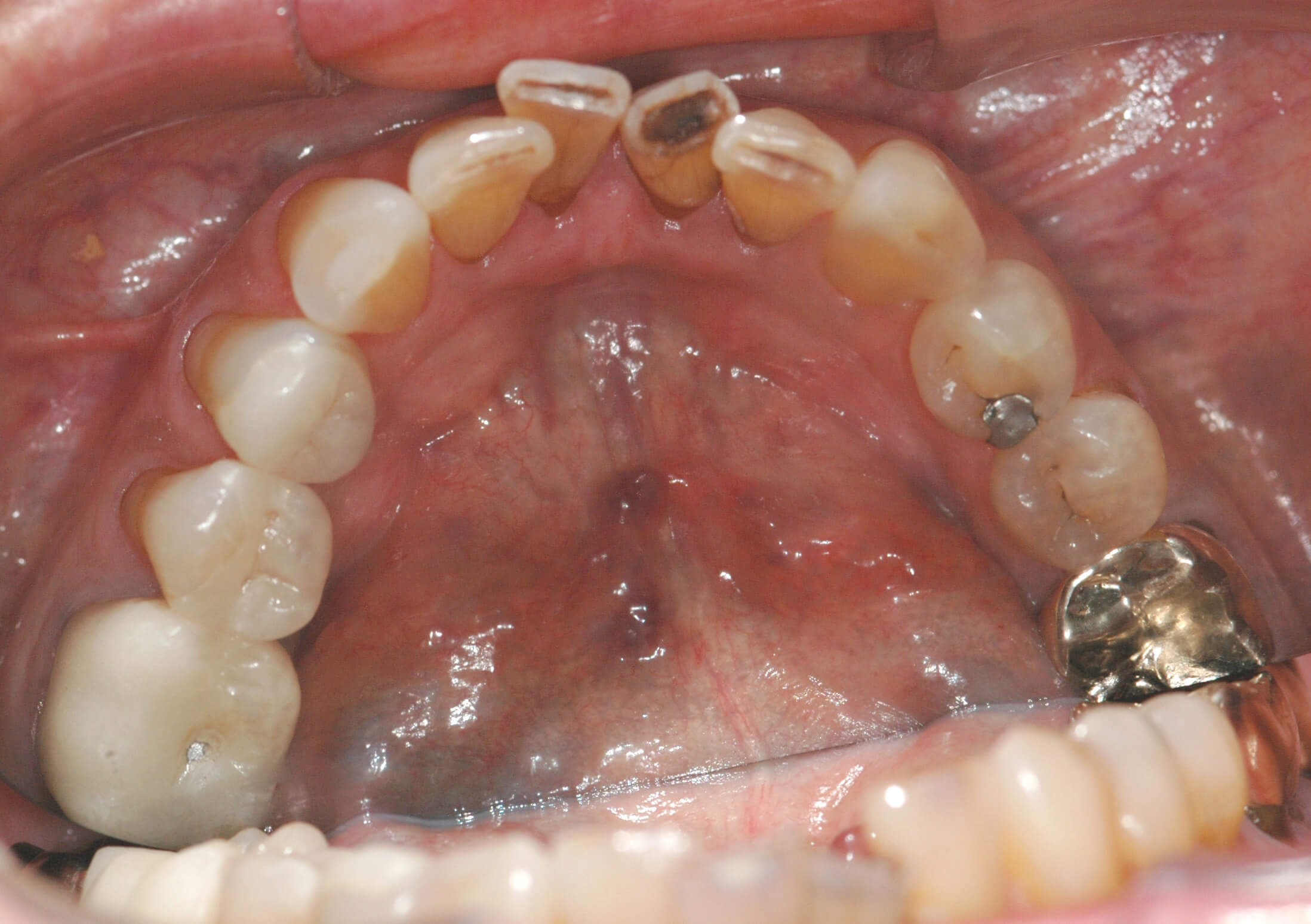 Her lower teeth Before from occlusal veiw
