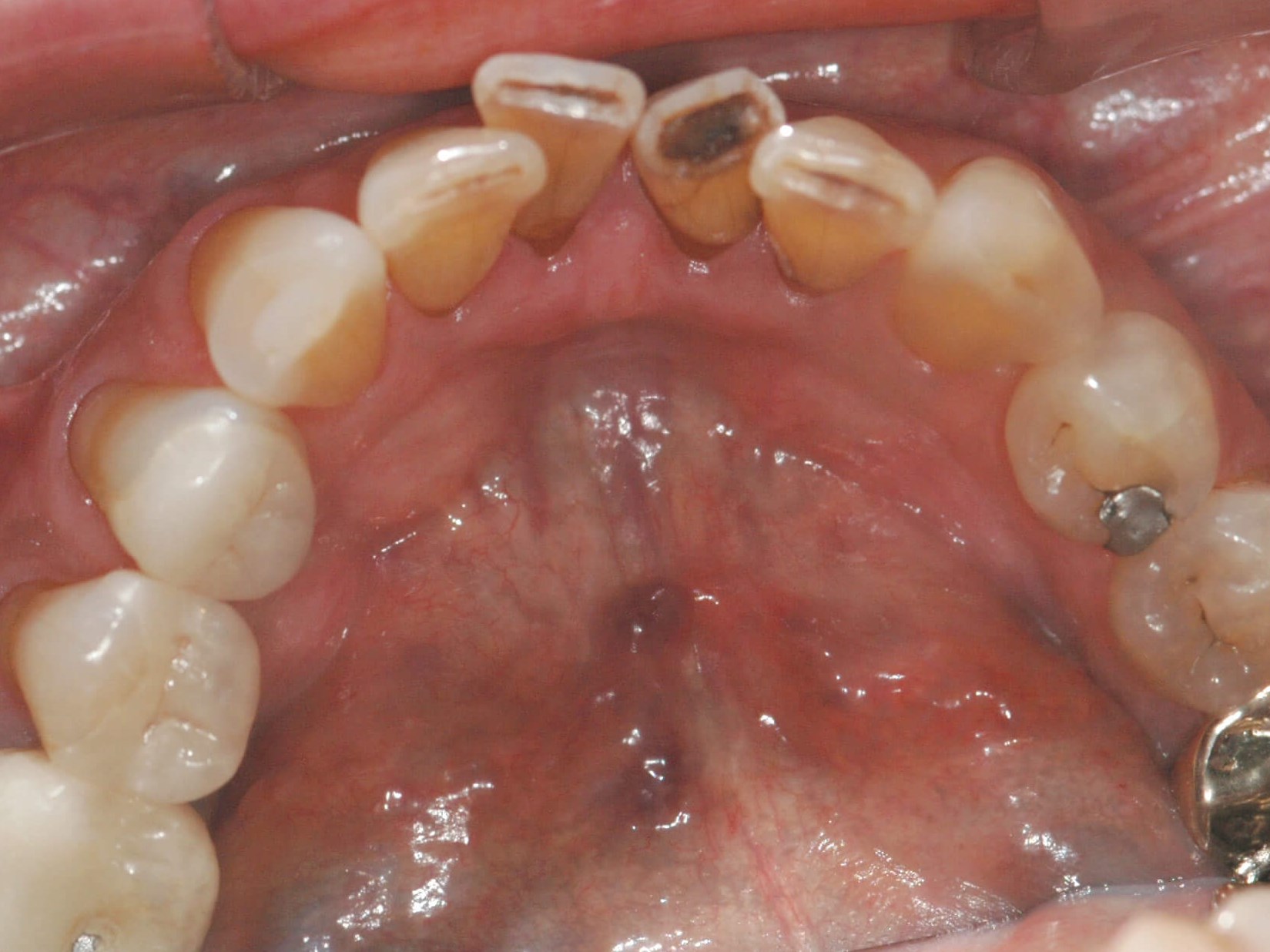 Her lower teeth Before from occlusal veiw