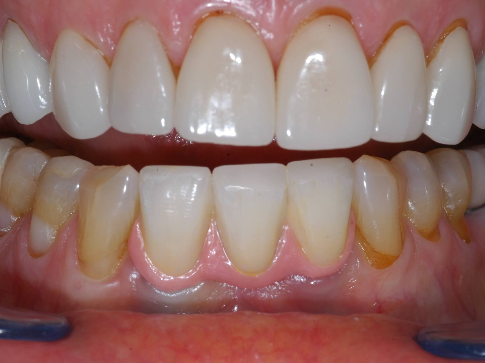 After implants and bridge After