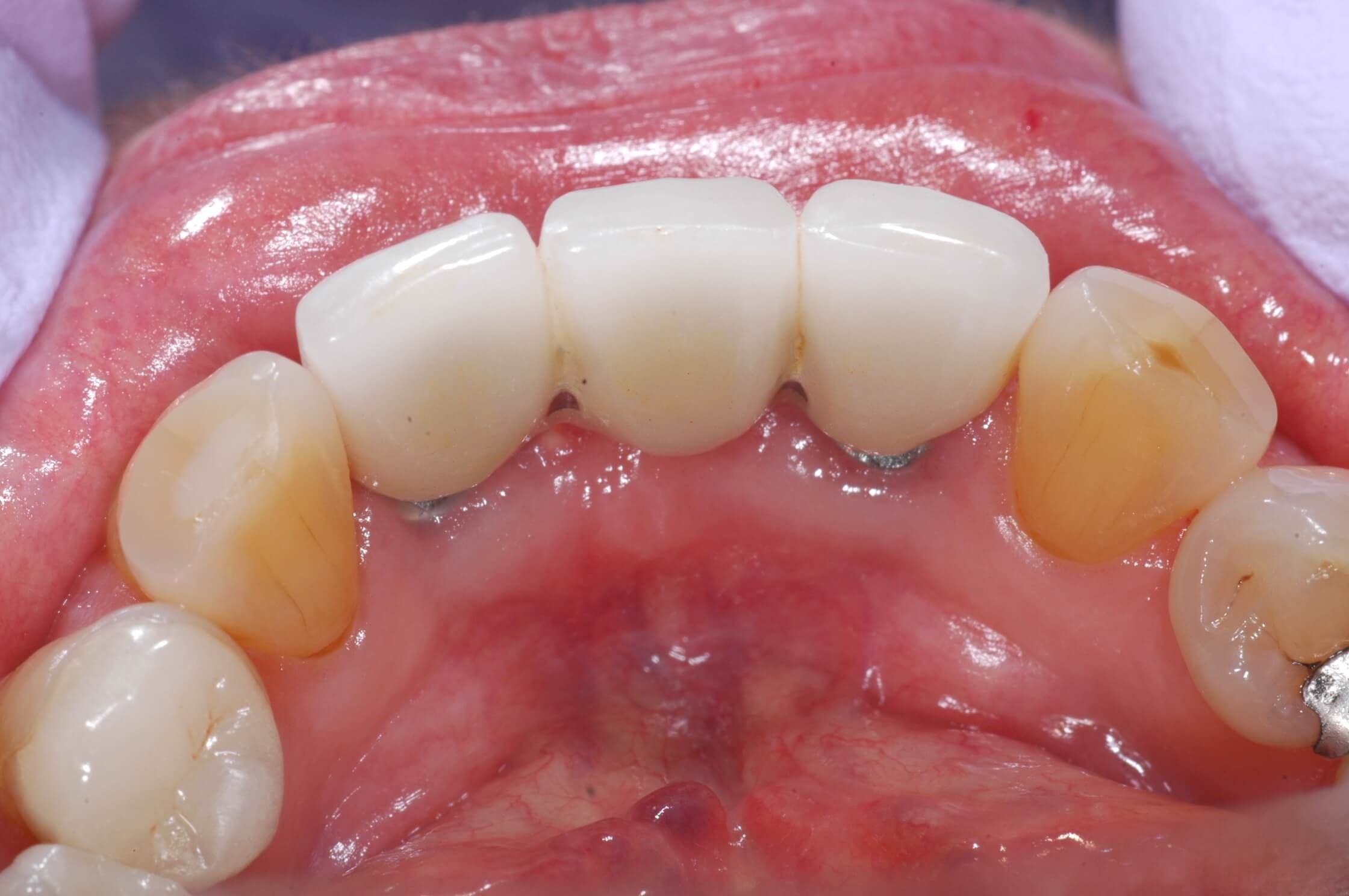 After implants and bridge After