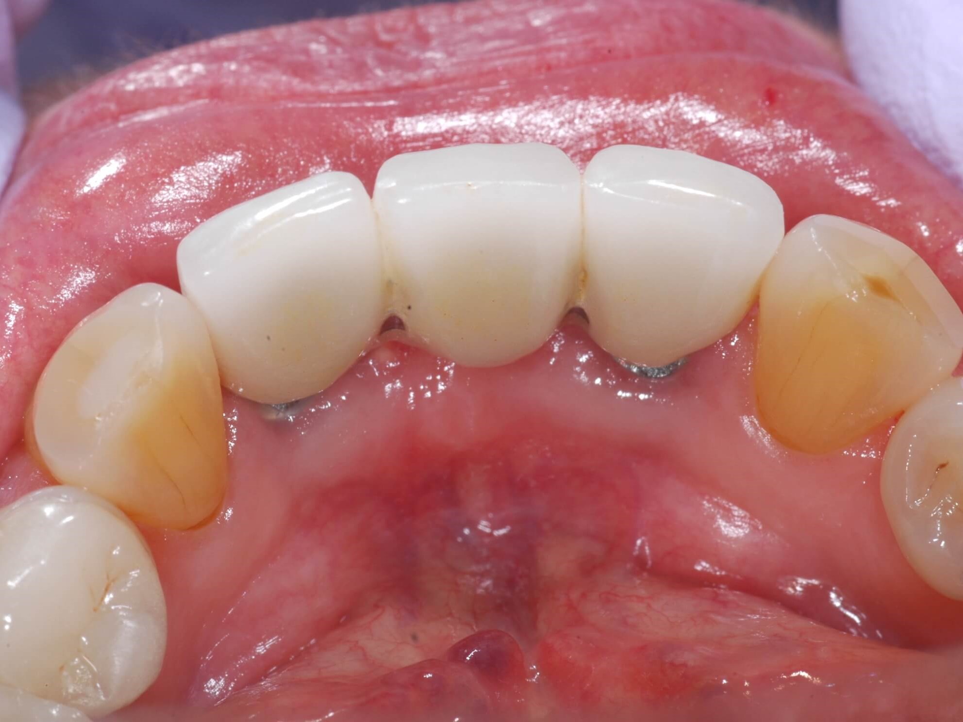 After implants and bridge After