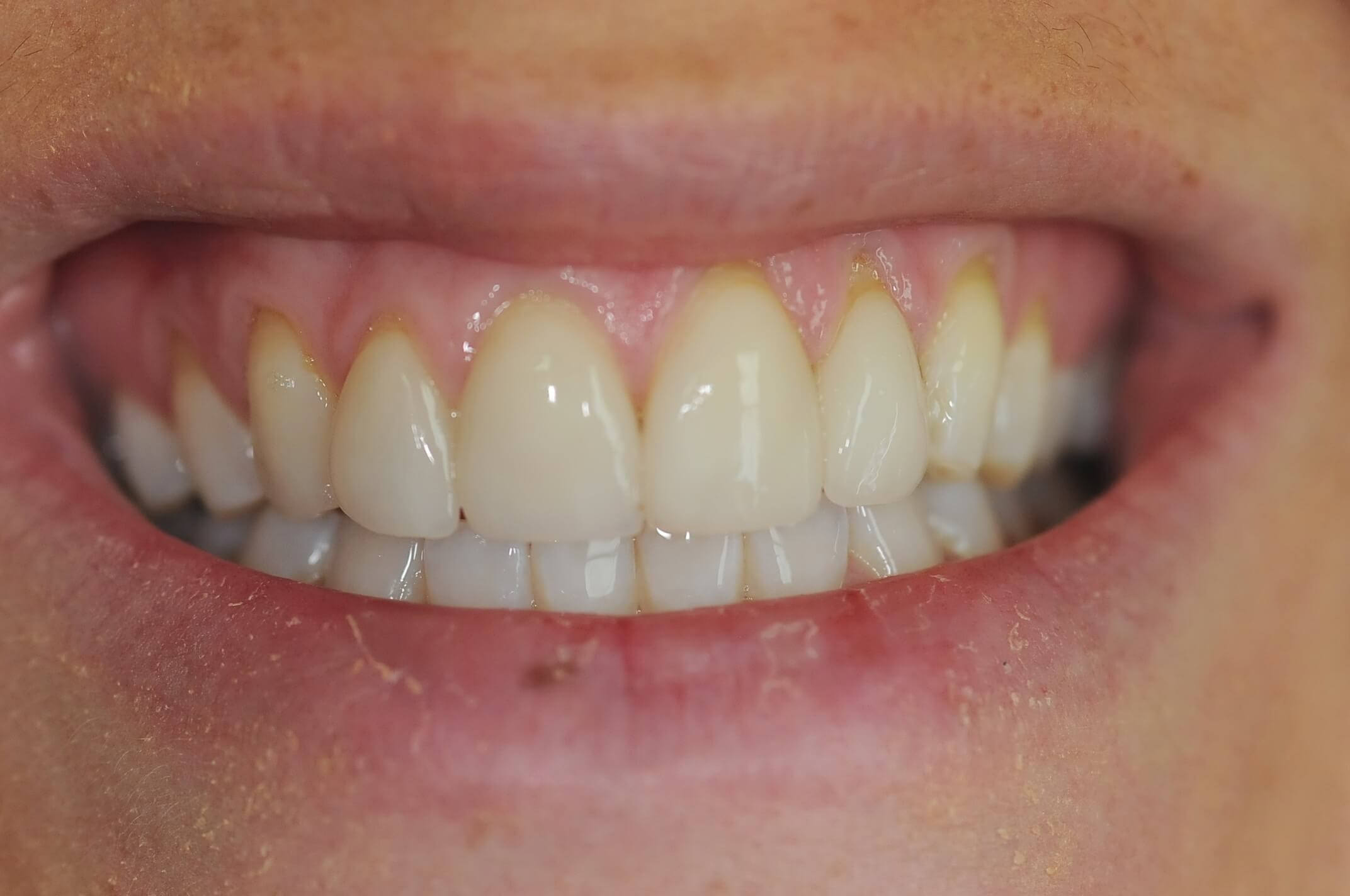 Full Smile Close up Before