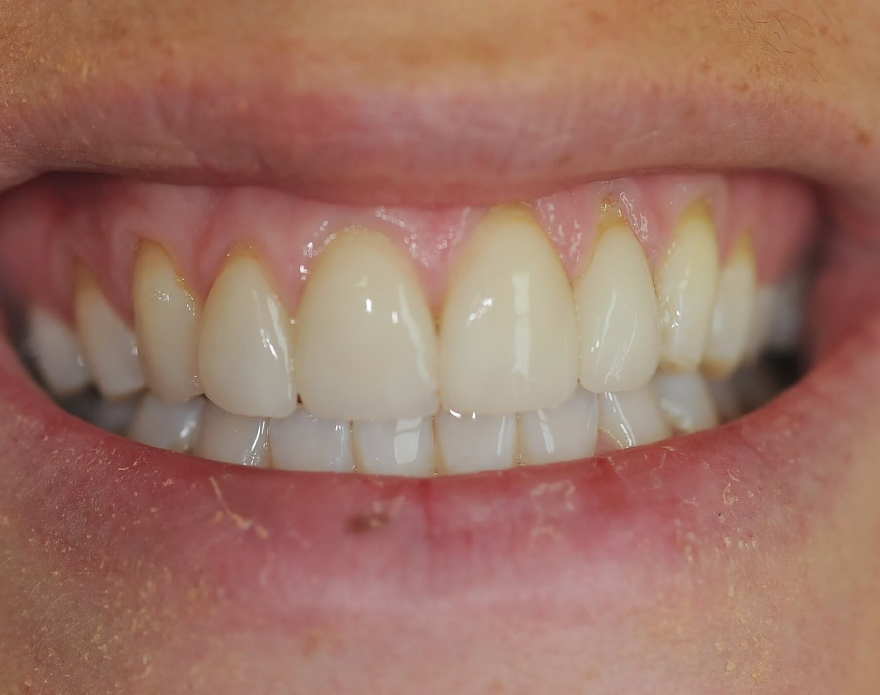 Full Smile Close up Before