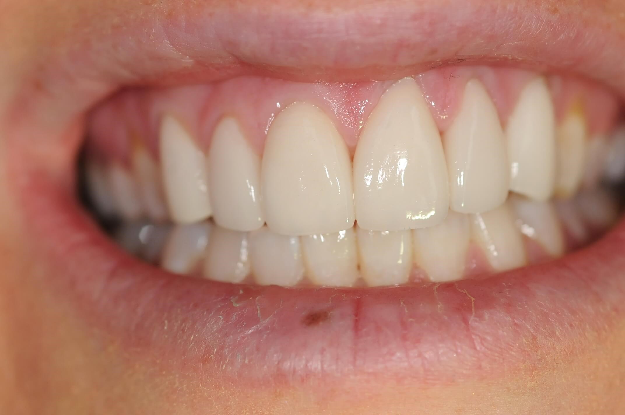 Full Smile Close up After