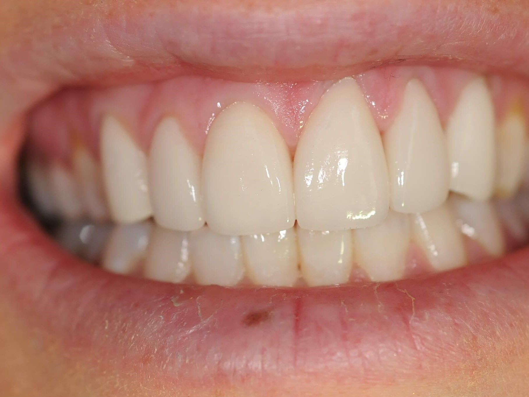 Full Smile Close up After