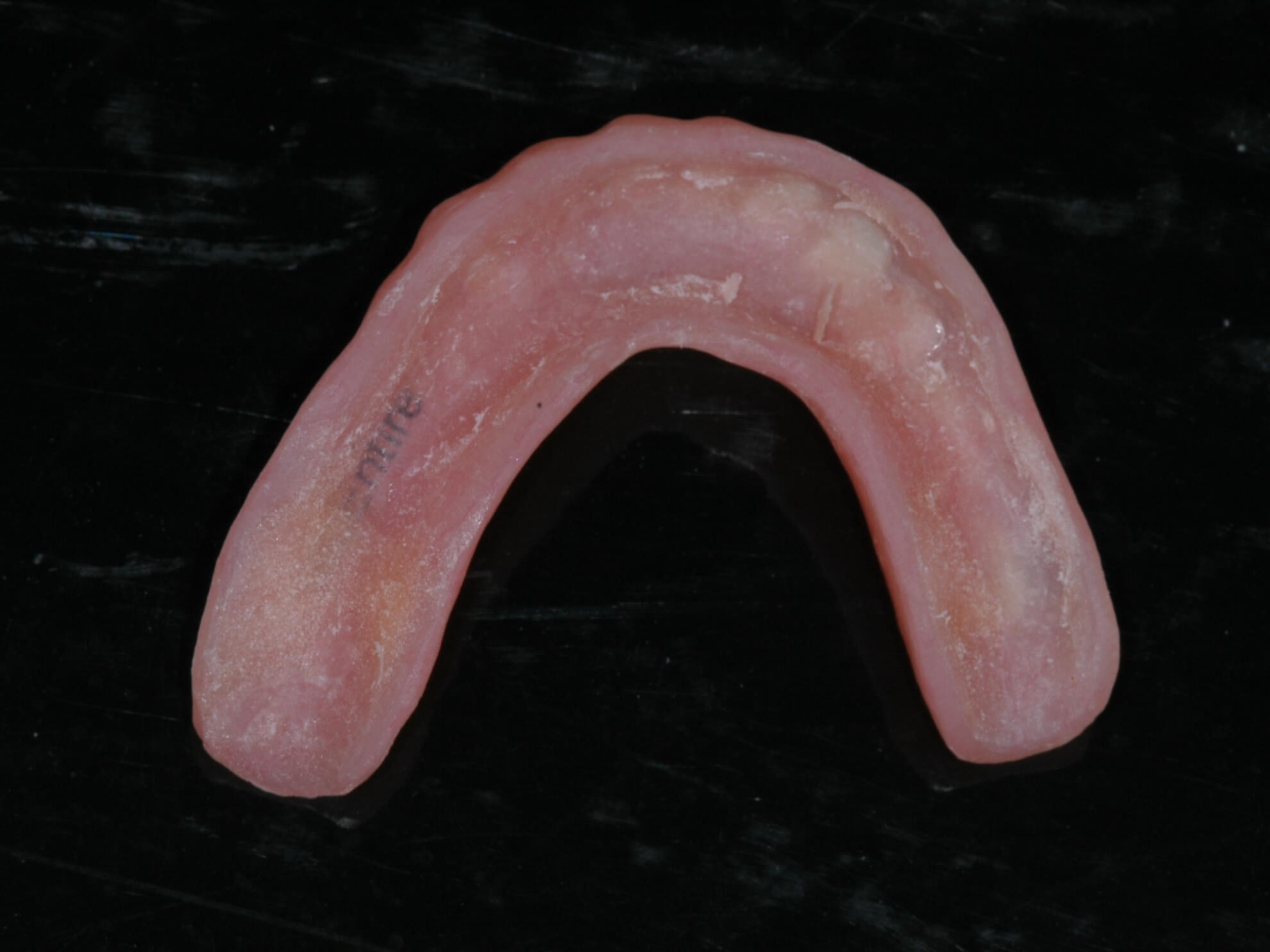 Implant supported denture Before