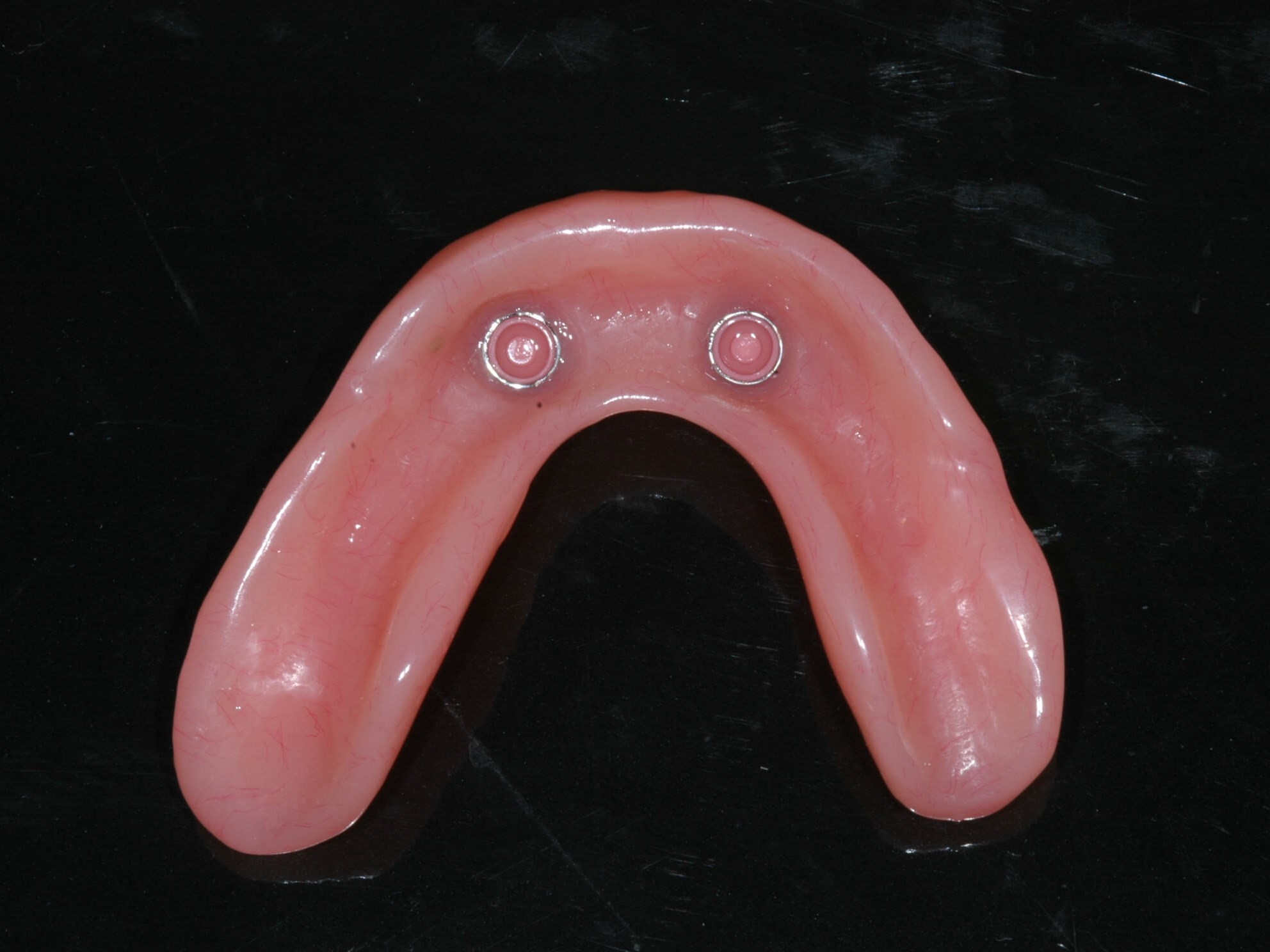 Implant supported denture After