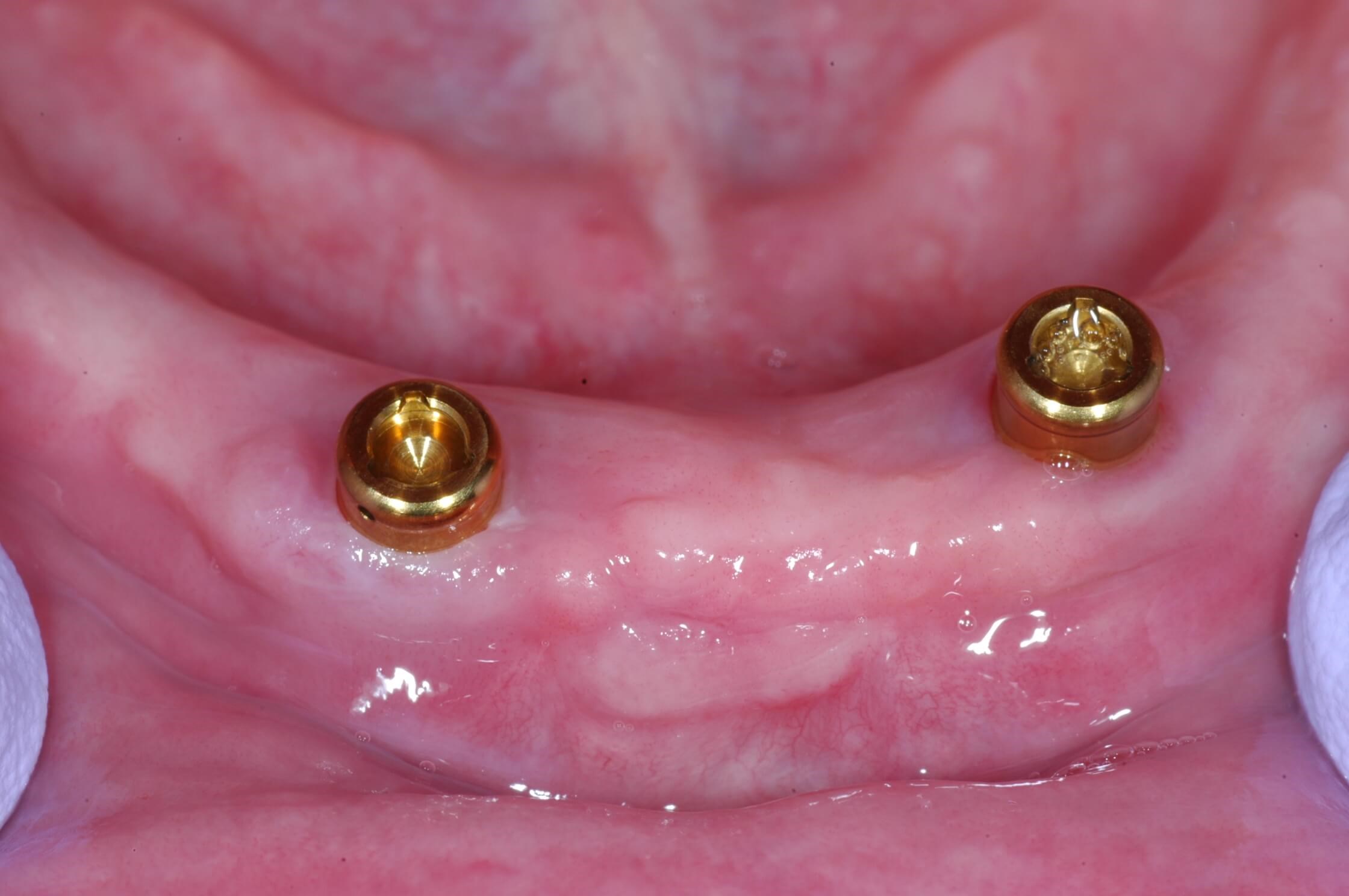 Locators 2 implants on lower arch