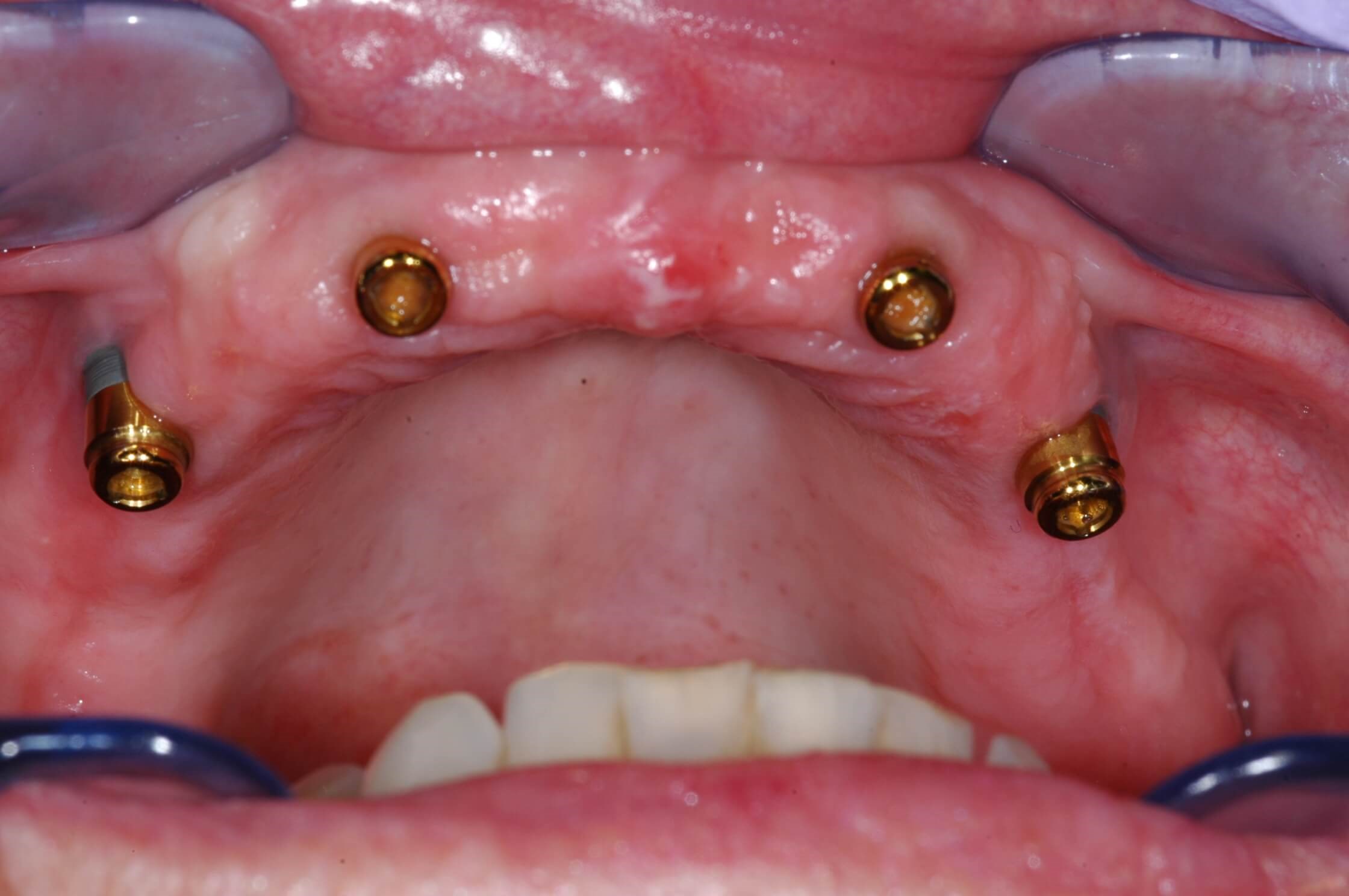 Locators 4 implants on upper arch