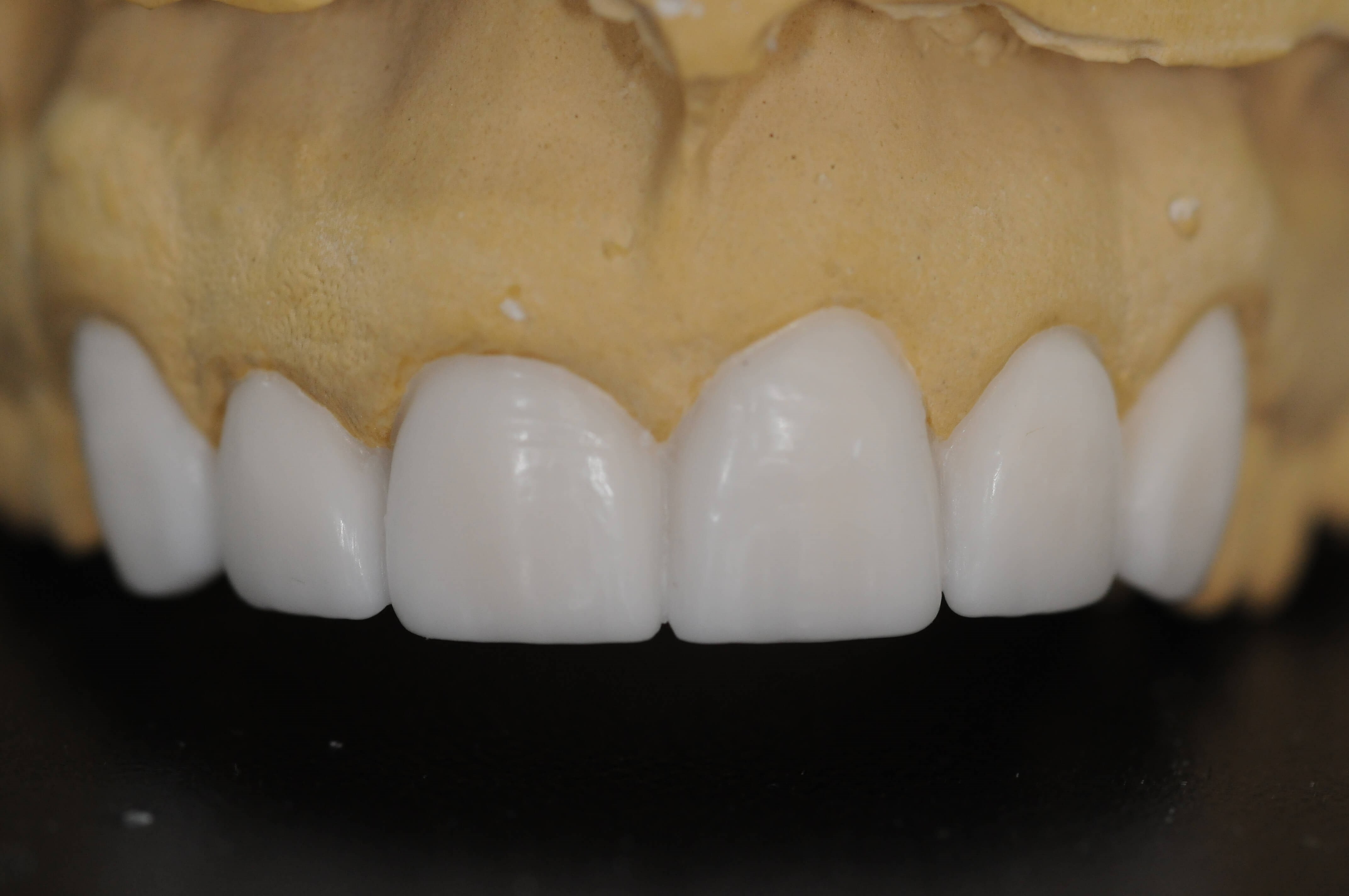 Wax up close ups Front view
