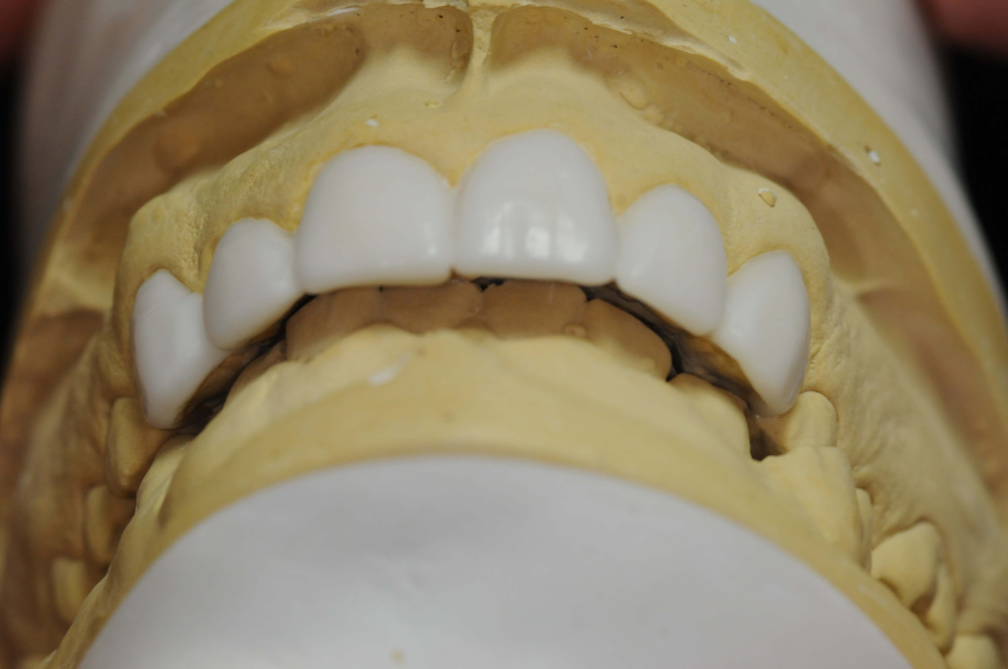 Wax up close ups Front View from Below