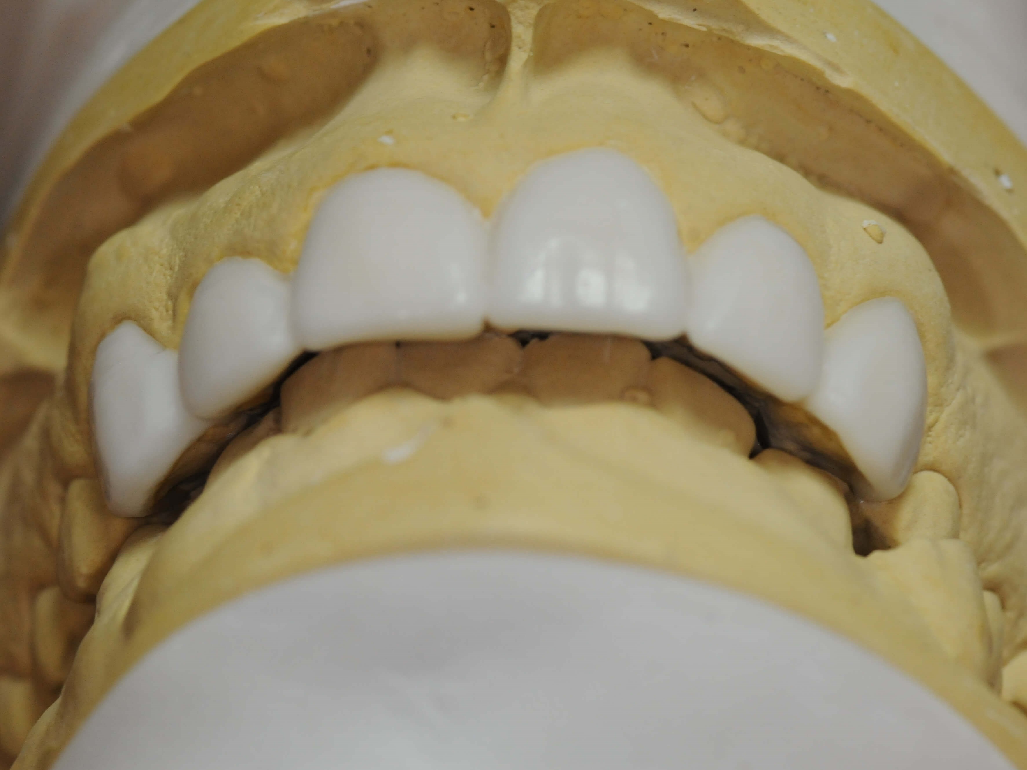 Wax up close ups Front View from Below