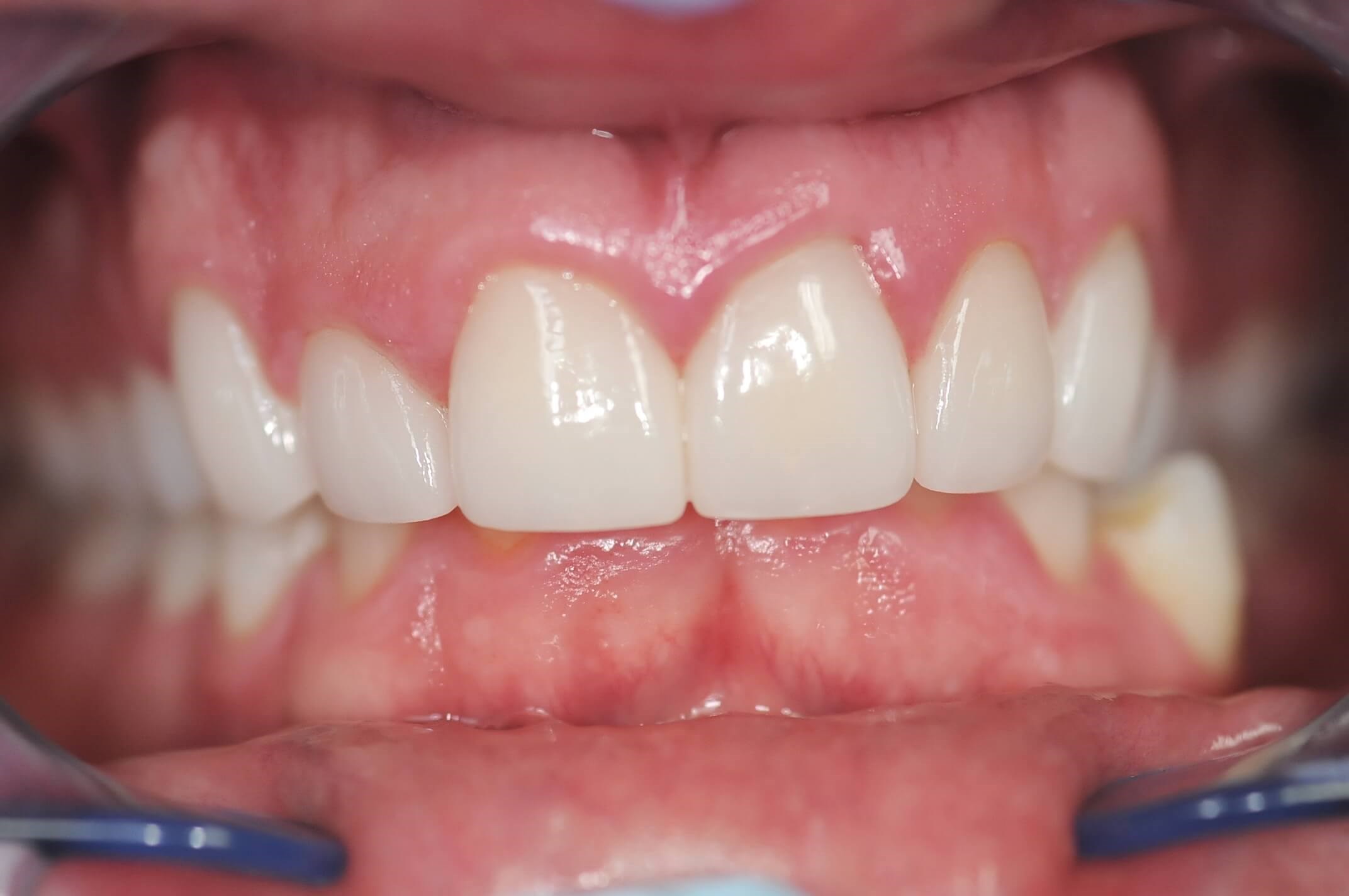The final results Retracted close up view