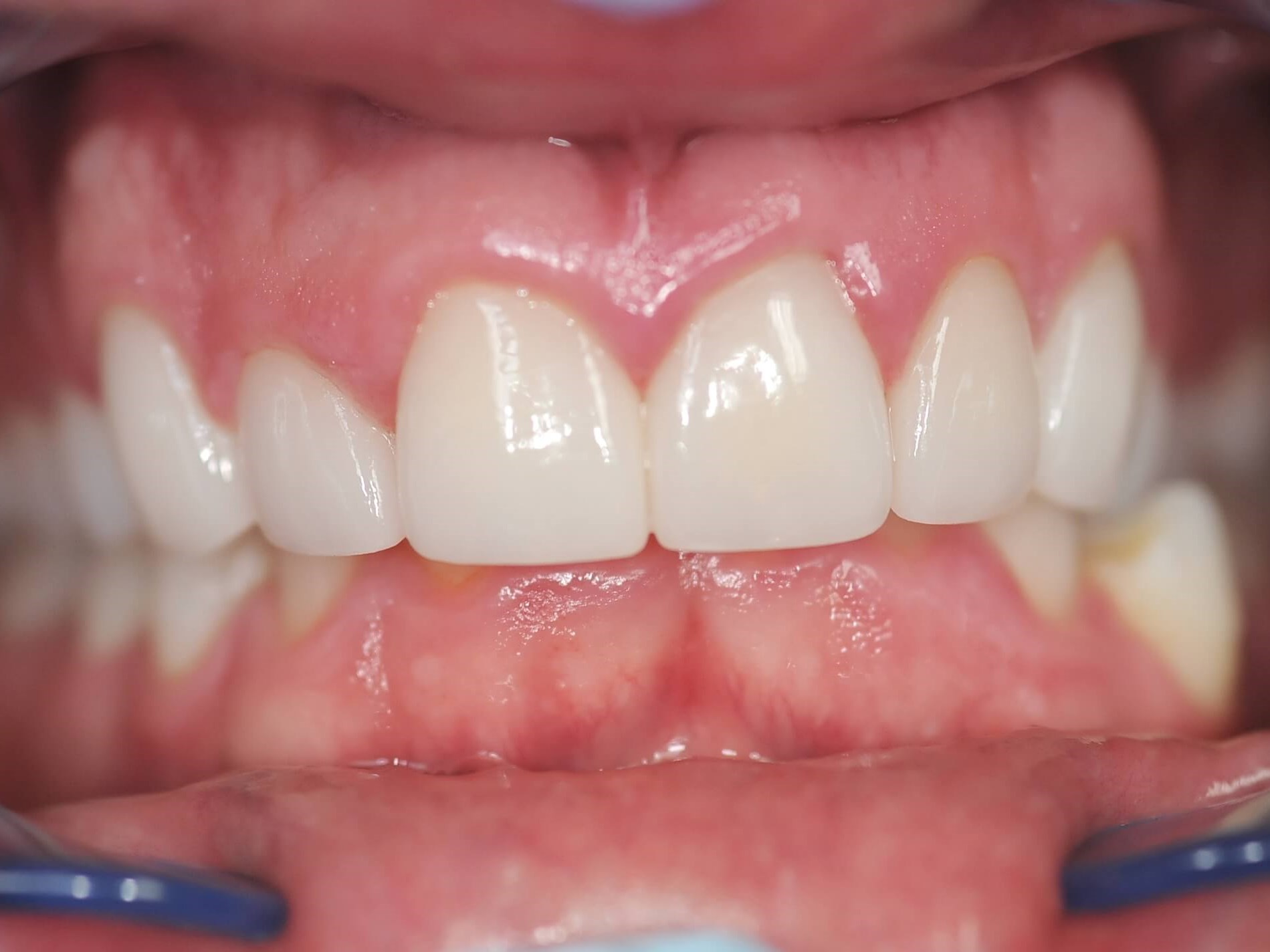 The final results Retracted close up view