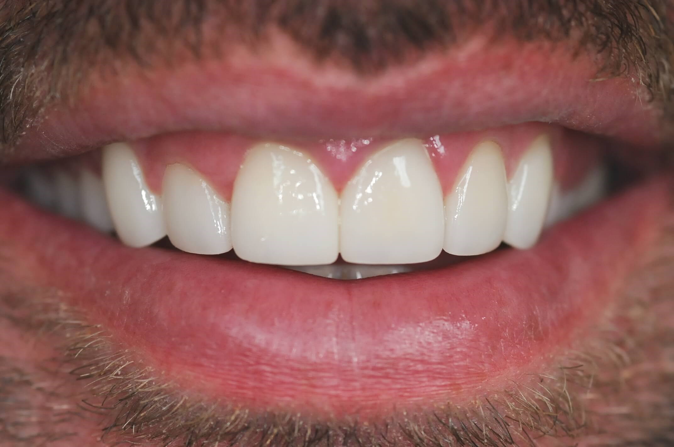The final results Full smile