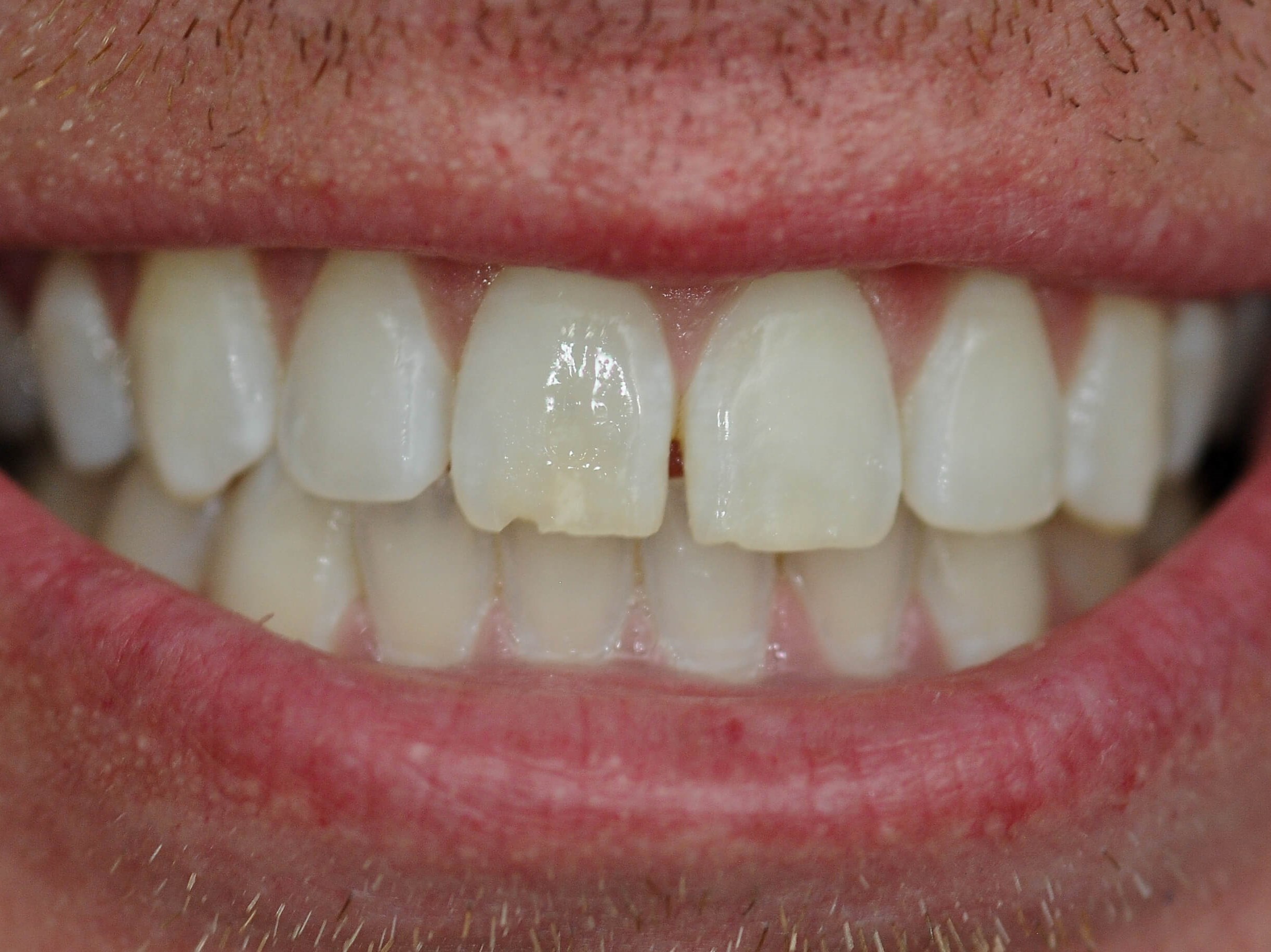 No Spaces After Veneers Before
