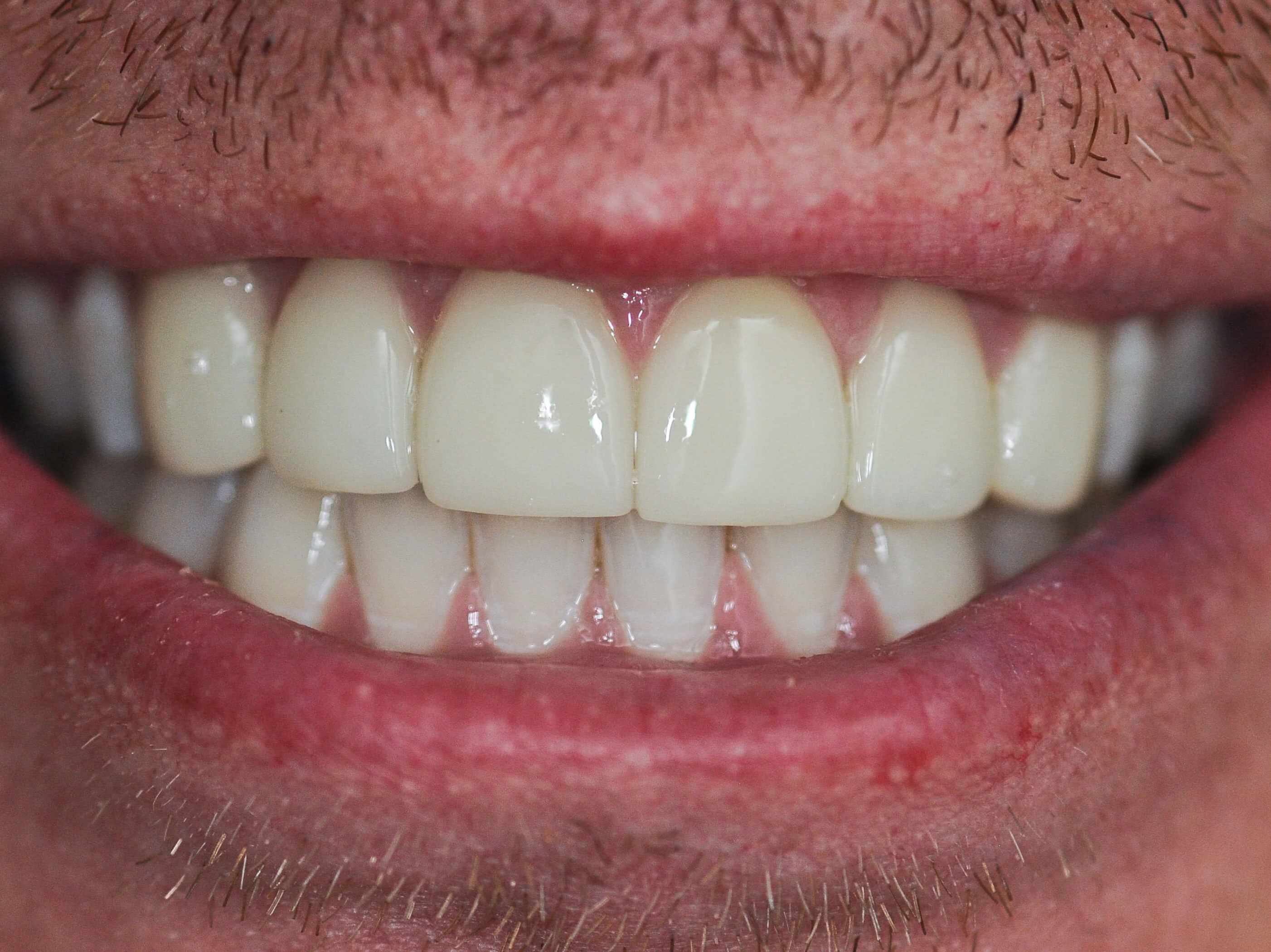 No Spaces After Veneers After