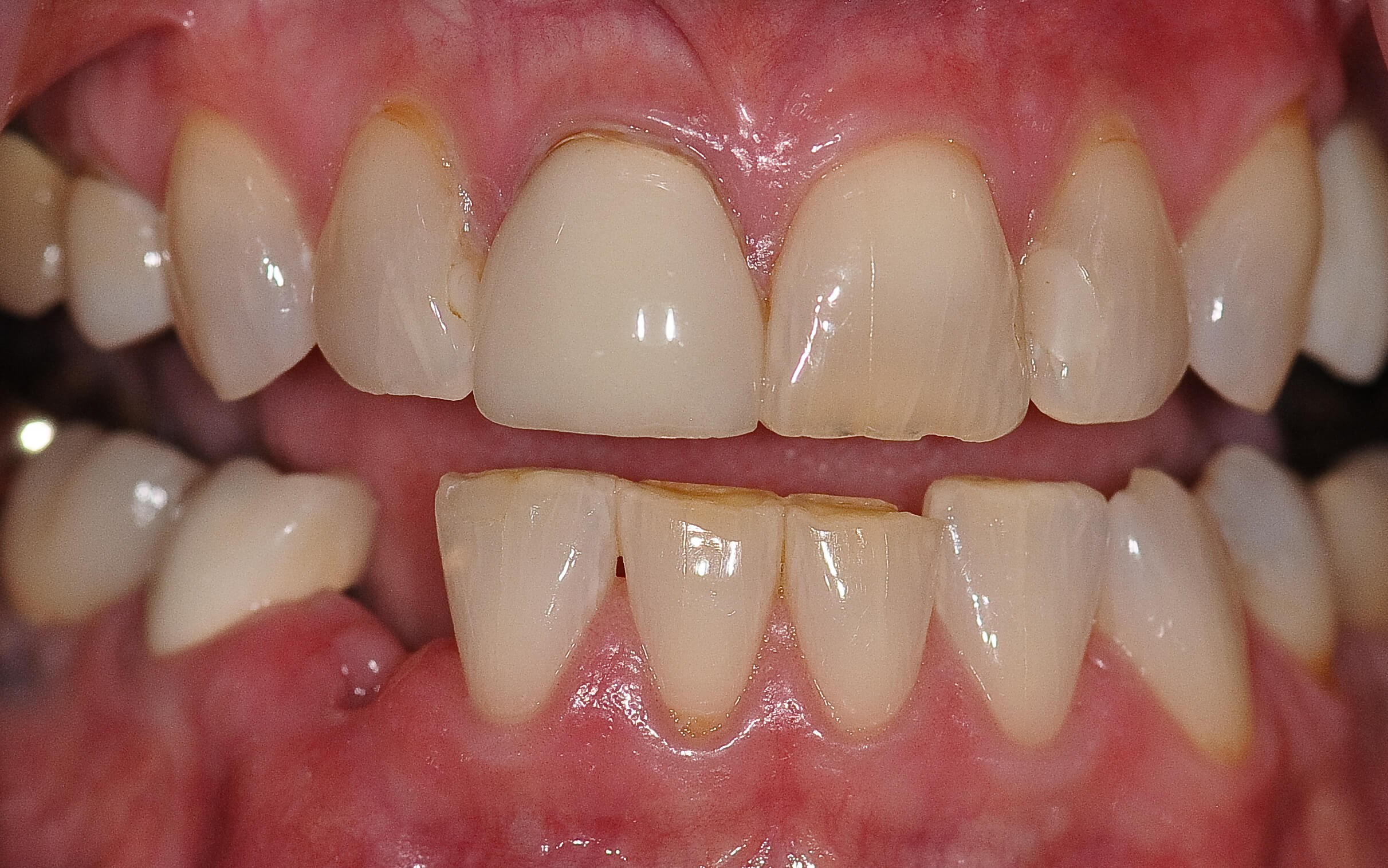 A Symmetrical Smile Makeover! Before
