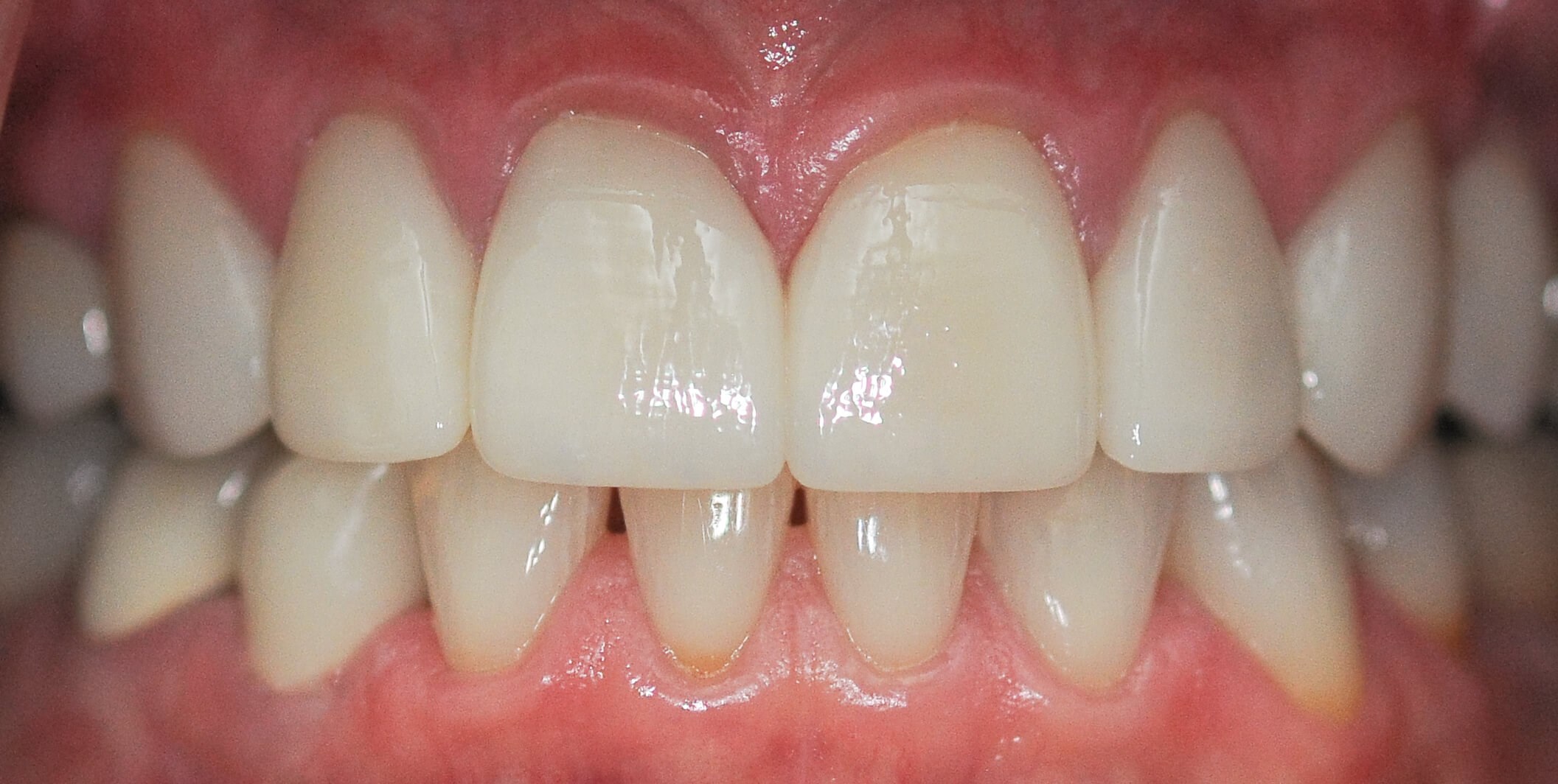A Symmetrical Smile Makeover! After
