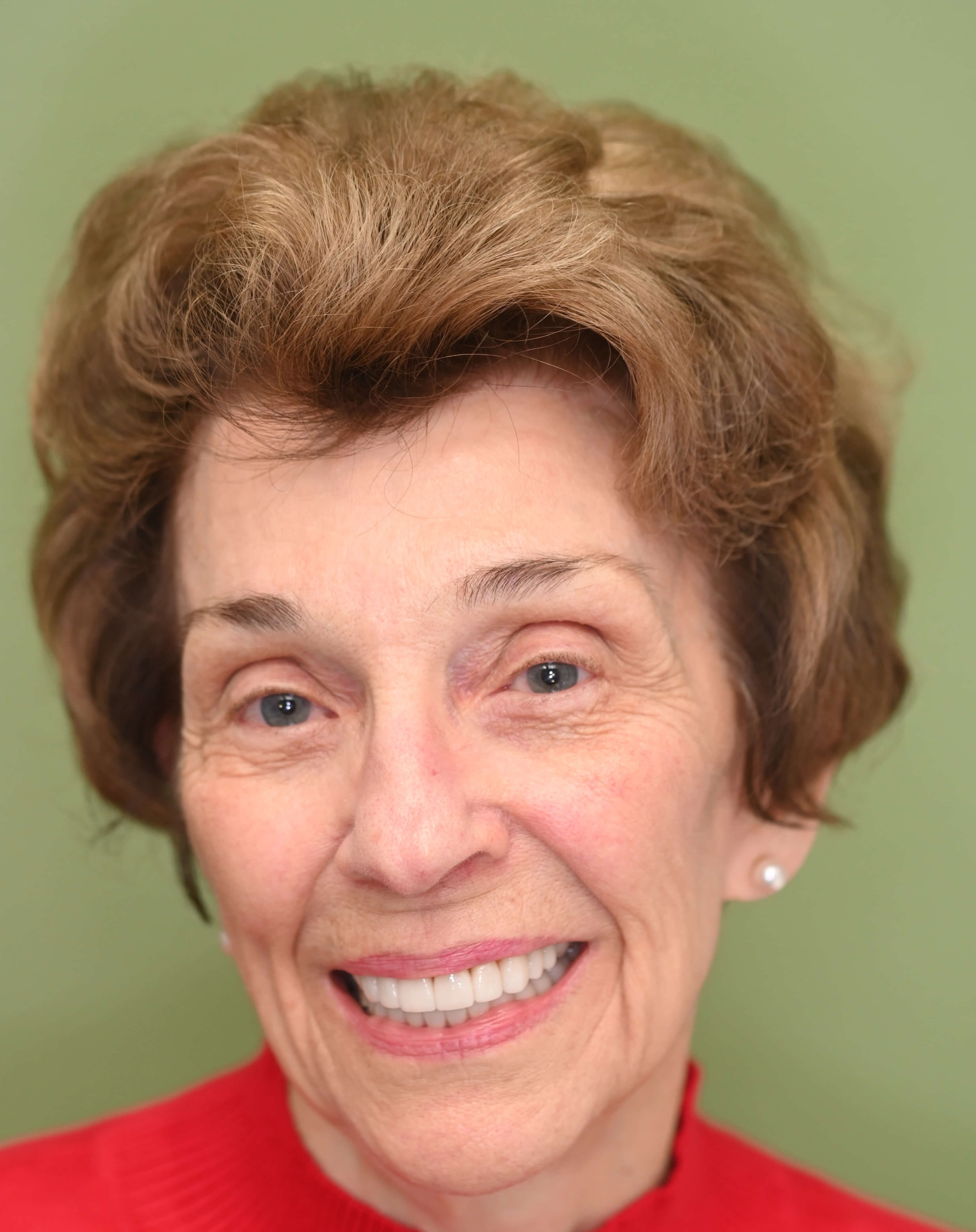 Veneers Renew Confidence After