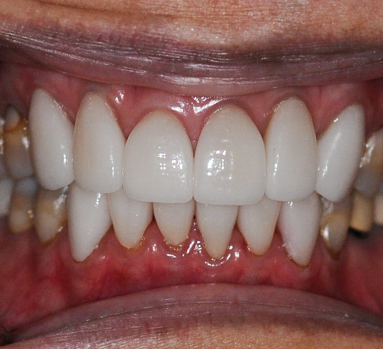 Back To A Happy Smile After